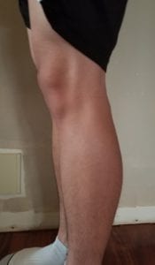 person 1 leg side view day 1