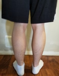 person 1 day 3 back of legs