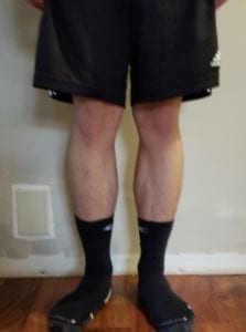 person 1 day 10 front of legs