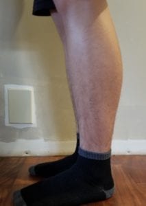 person 1 day 11 side of legs