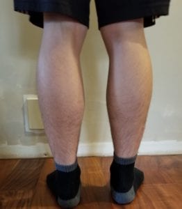 person 1 day 11 back of legs