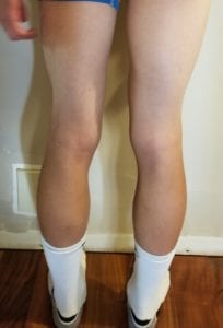 person 2 day 20 back of legs