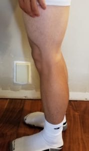 person 1 day 20 side of legs