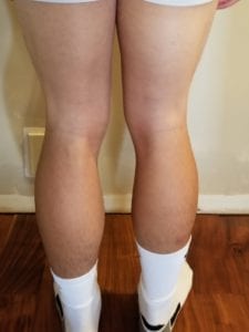 person 1 day 20 back of legs